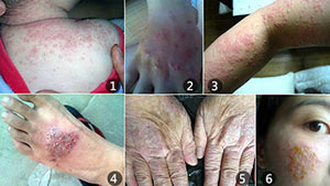 得了湿疹会产生哪些危害？