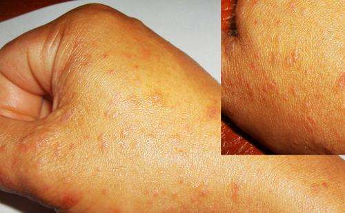 皮肤瘙痒发病要怎么预防